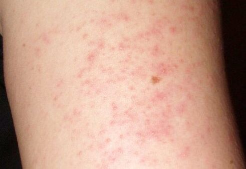 Itchy rashes a symptom of the presence of worms in the liver