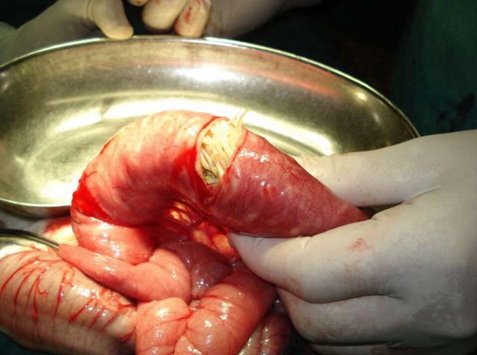 Pinworms in the human intestine